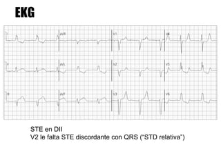 EKG




  STE en DII
  V2 le falta STE discordante con QRS (“STD relativa”)
 