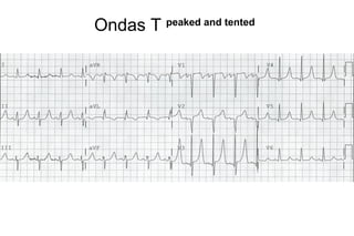 Ondas T peaked and tented
 