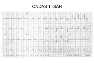 ONDAS T -SAH
 