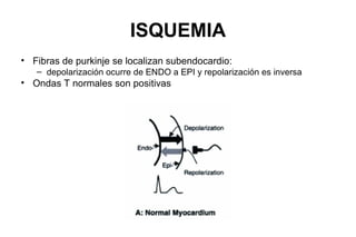 ISQUEMIA
• Fibras de purkinje se localizan subendocardio:
   – depolarización ocurre de ENDO a EPI y repolarización es inversa
• Ondas T normales son positivas
 