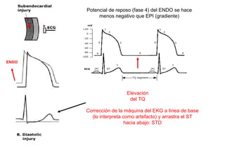 Potencial de reposo (fase 4) del ENDO se hace
            menos negativo que EPI (gradiente)




ENDO




                        Elevación
                         del TQ

       Corrección de la máquina del EKG a línea de base
         (lo interpreta como artefacto) y arrastra el ST
                         hacia abajo: STD
 