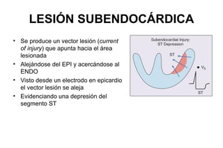 LESIÓN SUBENDOCÁRDICA
• Se produce un vector lesión (current
  of injury) que apunta hacia el área
  lesionada
• Alejándose del EPI y acercándose al
  ENDO
• Visto desde un electrodo en epicardio
  el vector lesión se aleja
• Evidenciando una depresión del
  segmento ST
 