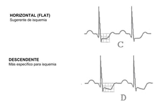 HORIZONTAL (FLAT)
Sugerente de isquemia




DESCENDENTE
Más específico para isquemia
 