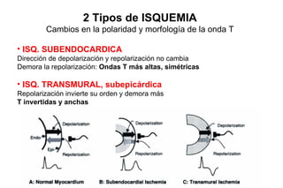 2 Tipos de ISQUEMIA
        Cambios en la polaridad y morfología de la onda T

• ISQ. SUBENDOCARDICA
Dirección de depolarización y repolarización no cambia
Demora la repolarización: Ondas T más altas, simétricas

• ISQ. TRANSMURAL, subepicárdica
Repolarización invierte su orden y demora más
T invertidas y anchas
 