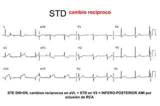 STD        cambio reciproco




STE DIII>DII, cambios recíprocos en aVL + STD en V2 = INFERO-POSTERIOR AMI por
                                  oclusión de RCA
 