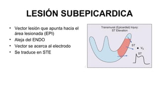 LESIÓN SUBEPICARDICA
• Vector lesión que apunta hacia el
  área lesionada (EPI)
• Aleja del ENDO
• Vector se acerca al electrodo
• Se traduce en STE
 