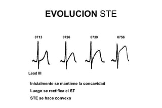 EVOLUCION STE




Inicialmente se mantiene la concavidad
Luego se rectifica el ST
STE se hace convexa
 