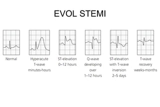 EVOL STEMI
 