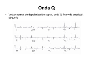 Onda Q
• Vector normal de depolarización septal, onda Q fina y de amplitud
  pequeña
 