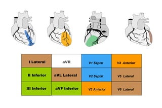 62            Jul 12, 2012January 2004




 I Lateral         aVR        V1 Septal             V4 Anterior


II Inferior    aVL Lateral    V2 Septal             V5 Lateral


III Inferior   aVF Inferior   V3 Anterior           V6 Lateral
 