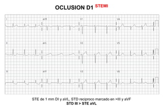 OCLUSION D1 STEMI




STE de 1 mm DI y aVL, STD reciproco marcado en >III y aVF
                   STD III > STE aVL
 
