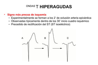 ONDAS
                          T HIPERAGUDAS
• Signo más precoz de isquemia
   – Experimentalmente se forman a los 2’ de oclusión arteria epicárdica
   – Observadas típicamente dentro de los 30’ inicio cuadro isquémico
   – Precedido de rectificación del ST (ST isoeléctrico)
 