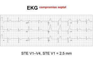 EKG    compromiso septal




STE V1–V4, STE V1 = 2.5 mm
 