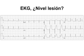 EKG, ¿Nivel lesión?
 