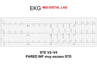 EKG   MID-DISTAL LAD




       STE V2–V4
PARED INF muy escaso STD
 