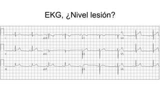 EKG, ¿Nivel lesión?
 