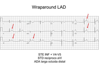 Wraparound LAD




  STE INF + V4-V5
  STD reciproco aVl
ADA larga ocluida distal
 