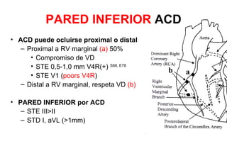 PARED INFERIOR ACD
• ACD puede ocluirse proximal o distal
   – Proximal a RV marginal (a) 50%
      • Compromiso de VD
      • STE 0,5-1,0 mm V4R(+) S88, E78
      • STE V1 (poors V4R)
   – Distal a RV marginal, respeta VD (b)

• PARED INFERIOR por ACD
   – STE III>II
   – STD I, aVL (>1mm)
 