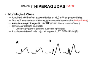 ONDAS
                     T HIPERAGUDAS HATW
• Morfología & Clues
  – Amplitud >0.5mV en extremidades y >1,0 mV en precordiales
  – Ondas T levemente asimétricas, grandes y de base ancha (bulky & wide)
  – Asociadas a prolongación del QT (dif Hi-K+: Narrow pointed & Tented)
  – Considerar relación con QRS
     • Con QRS pequeño T pequeña puede ser hiperaguda
  – Asociado a take-off más bajo del segmento ST, STD J Point (B)
 