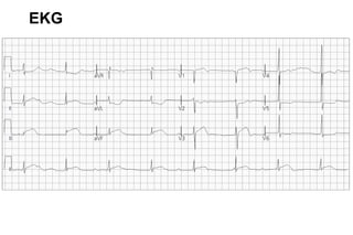 EKG
 