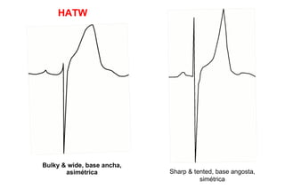HATW




Bulky & wide, base ancha,
       asimétrica           Sharp & tented, base angosta,
                                      simétrica
 