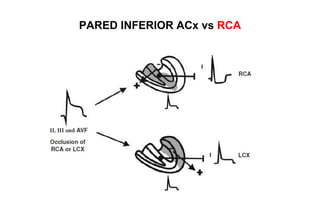 PARED INFERIOR ACx vs RCA
 