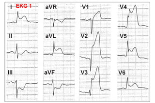 EKG 1
 