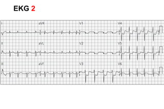 EKG 2
 