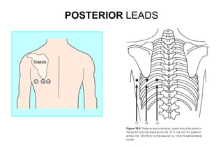 POSTERIOR LEADS
 