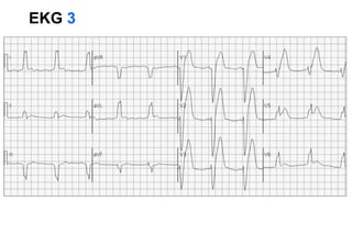 EKG 3
 