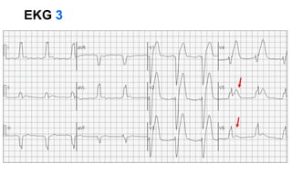 EKG 3
 