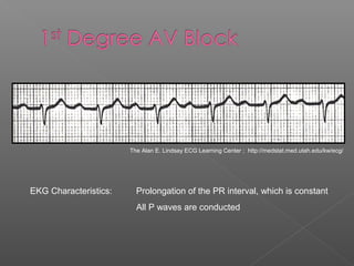 EKG Characteristics: Prolongation of the PR interval, which is constant
All P waves are conducted
The Alan E. Lindsay ECG Learning Center ; http://medstat.med.utah.edu/kw/ecg/
 