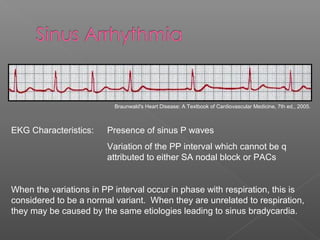 EKG Characteristics: Presence of sinus P waves
Variation of the PP interval which cannot be q
attributed to either SA nodal block or PACs
When the variations in PP interval occur in phase with respiration, this is
considered to be a normal variant. When they are unrelated to respiration,
they may be caused by the same etiologies leading to sinus bradycardia.
Braunwald's Heart Disease: A Textbook of Cardiovascular Medicine, 7th ed., 2005.
 