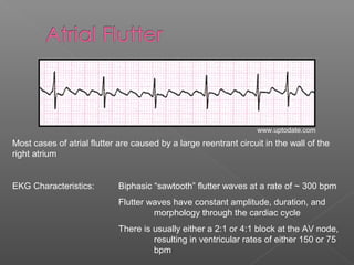 Most cases of atrial flutter are caused by a large reentrant circuit in the wall of the
right atrium
EKG Characteristics: Biphasic “sawtooth” flutter waves at a rate of ~ 300 bpm
Flutter waves have constant amplitude, duration, and
morphology through the cardiac cycle
There is usually either a 2:1 or 4:1 block at the AV node,
resulting in ventricular rates of either 150 or 75
bpm
www.uptodate.com
 