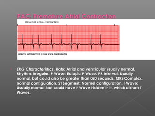  EKG Characteristics. Rate: Atrial and ventricular usually normal.
Rhythm: Irregular. P Wave: Ectopic P Wave. PR Interval: Usually
normal, but could also be greater than 020 seconds. QRS Complex:
normal configuration. ST Segment: Normal configuration. T Wave:
Usually normal, but could have P Wave hidden in it, which distorts T
Waves. 
 