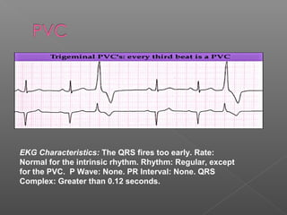 EKG Characteristics: The QRS fires too early. Rate:
Normal for the intrinsic rhythm. Rhythm: Regular, except
for the PVC. P Wave: None. PR Interval: None. QRS
Complex: Greater than 0.12 seconds.
 