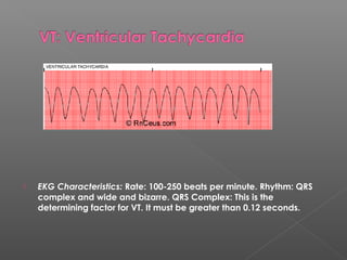  EKG Characteristics: Rate: 100-250 beats per minute. Rhythm: QRS
complex and wide and bizarre. QRS Complex: This is the
determining factor for VT. It must be greater than 0.12 seconds.
 