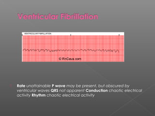  Rate unattainable P wave may be present, but obscured by
ventricular waves QRS not apparent Conduction chaotic electrical
activity Rhythm chaotic electrical activity
 