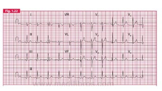 ELECTROCARDIOGRAMA RITMO SINUSAL 2..pptx
