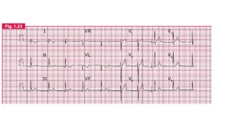ELECTROCARDIOGRAMA RITMO SINUSAL 2..pptx