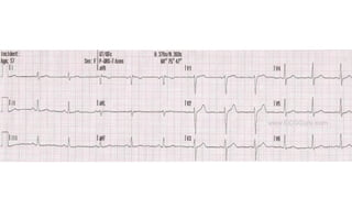 ELECTROCARDIOGRAMA RITMO SINUSAL 2..pptx