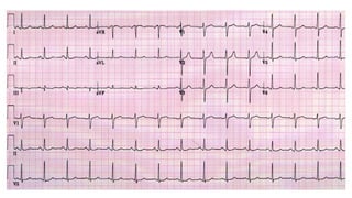 ELECTROCARDIOGRAMA RITMO SINUSAL 2..pptx