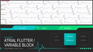 Ekgskillspractice atrial arrhythmias | PPT