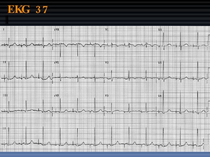 Ekg Test Upload