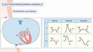 ELECTROCARDIOGRAMA ANÓMALO
Anomalías auriculares:
 