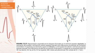 BLOQUEOS
FASCICULARES
( HEMIBLOQUEOS)
 