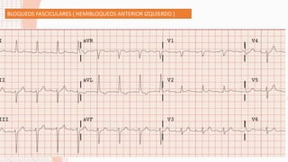 BLOQUEOS FASCICULARES ( HEMIBLOQUEOS ANTERIOR IZQUIERDO )
 