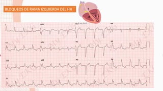BLOQUEOS DE RAMA IZQUIERDA DEL HH
 
