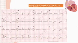 BLOQUEOS DE RAMA DERECHA DEL HH
 