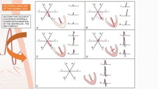 VECTORIAL ANALYSIS
OF THE NORMAL EKG
VECTORS THAT OCCUR AT
SUCCESSIVE INTERVALS
DURING DEPOLARIZATION
OF THE VENTRICLES - THE
QRS COMPLEX
 